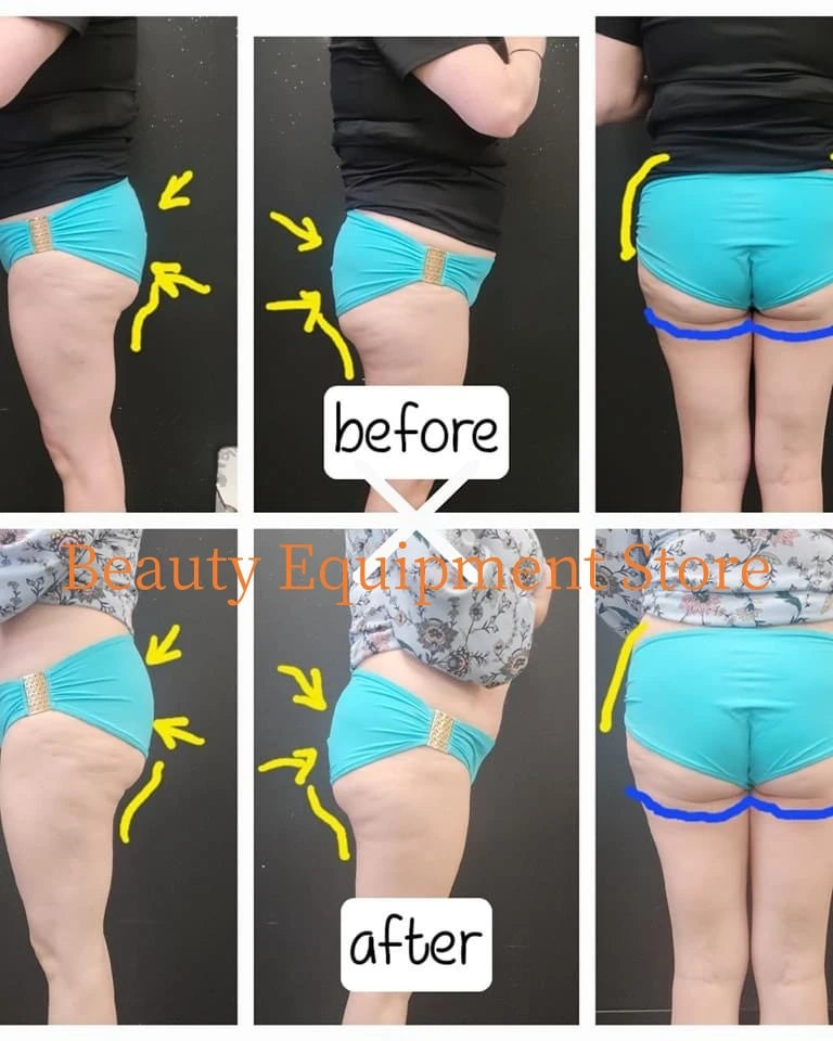 EMS Weight Loss Stimulating Muscle Slimming Fat Removal Muscle Fitness Sculpting MYOslim Machine 4 Handles Beauty Salon