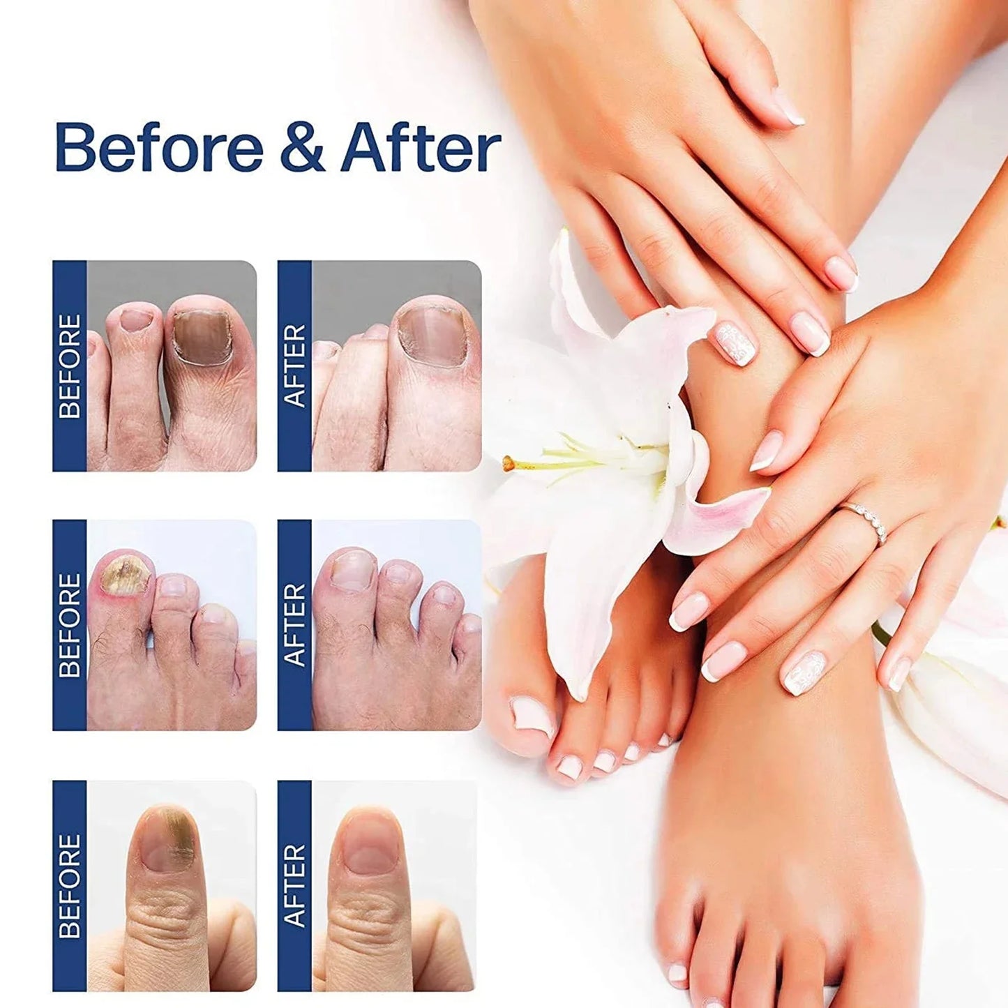 Nail Fungus Treatment 20ml Nails Repair Essence Liquid Renew Damaged Broken Cracked & Discolored Nails for Damaged Nail Uñas